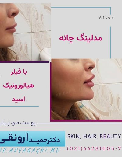 مدلینگ چانه
