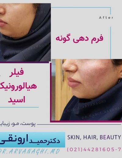 فرم دهی گونه