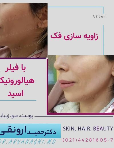 زاویه سازی صورت