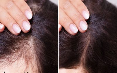 عوارض خطرناک مزوتراپی مو کدامند؟