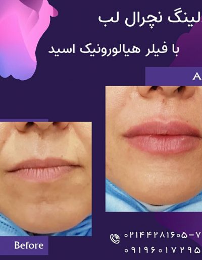 هیالورونیک اسید