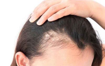 ریزش مو پس از کرونا و درمان آن
