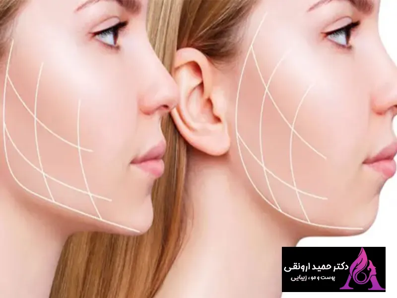 هزینه مادلینگ صورت