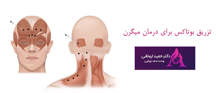 تزریق بوتاکس برای درمان میگرن