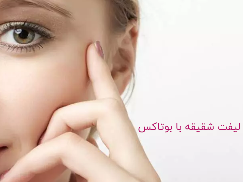 لیفت شقیقه با بوتاکس چگونه انجام می‌شود؟