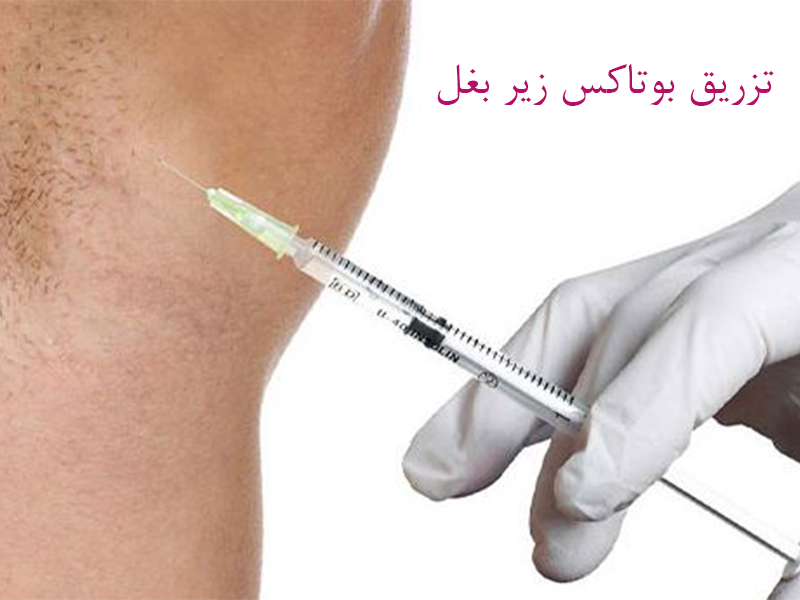 آیا تزریق بوتاکس زیر بغل می‌تواند تعریق را کاهش دهد؟