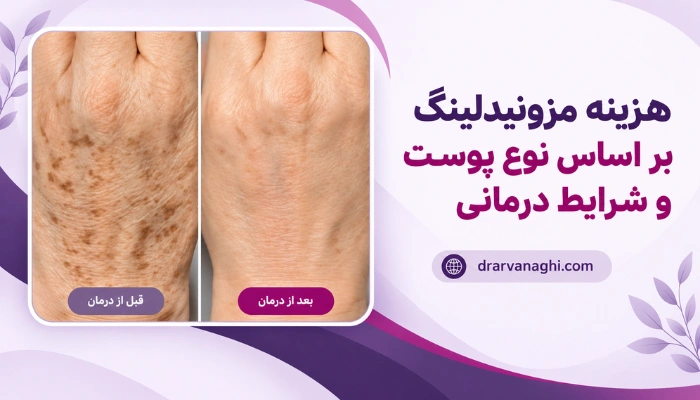 هزینه مزونیدلینگ بر اساس نوع پوست و شرایط درمانی قبل و بعد از بهبود پوست
