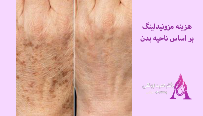 هزینه-مزونیدلینگ-بر-اساس-ناحیه-بدن
