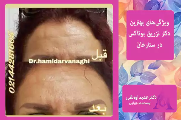 ویژگی‌های بهترین دکتر تزریق بوتاکس در ستارخان