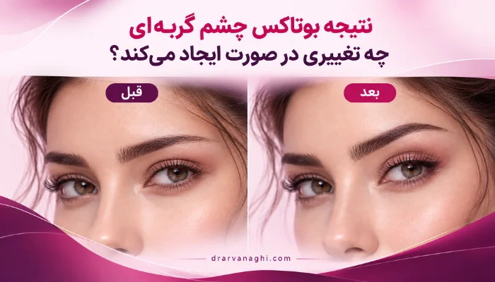 مقایسه قبل و بعد از بوتاکس چشم گربه ای و تغییر حالت دم ابرو و کشیدگی ظاهری چشم