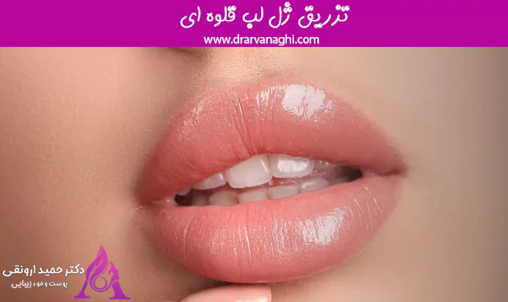 تزریق ژل لب قلوه ای