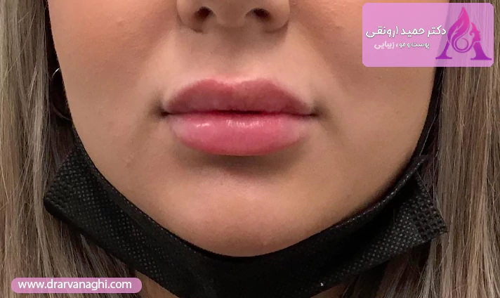 نحوه انجام تزریق ژل لب قلوه ای