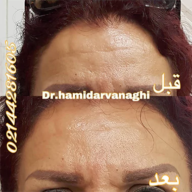 تزریق بوتاکس