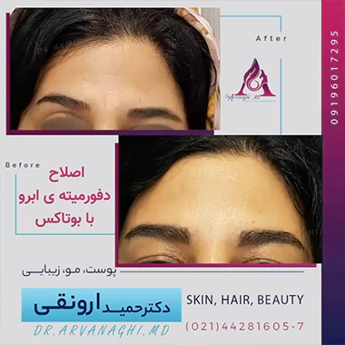 نمونه کار تزریق بوتاکس