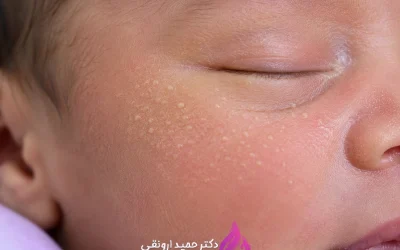 میلیا چیست؟
