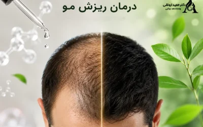 بهترین روش درمان ریزش مو