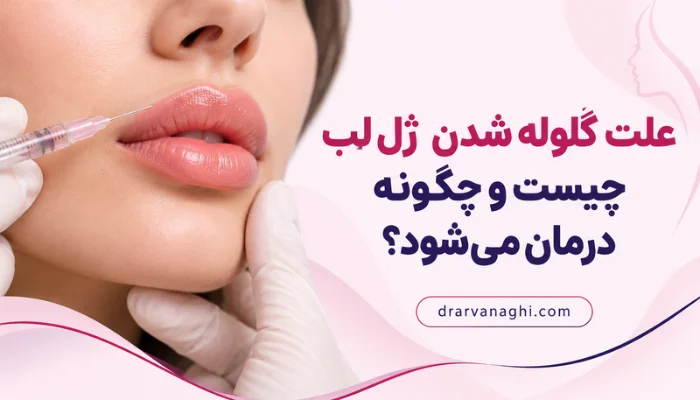 علت گلوله شدن ژل لب بعد از تزریق فیلر و روشهای درمان آن
