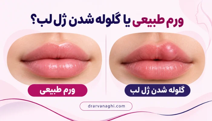 تفاوت ورم طبیعی بعد از تزریق ژل لب با ایجاد توده و برجستگی موضعی